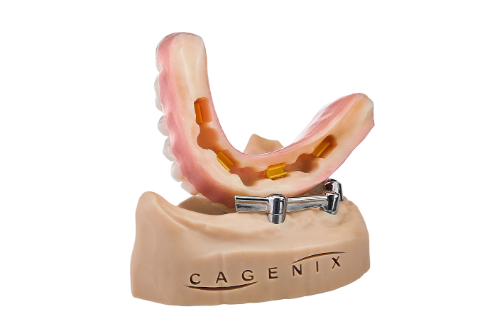 AccuFrame Overdenture 2